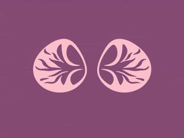 Breast Florid Ductal Hyperplasia Pathology