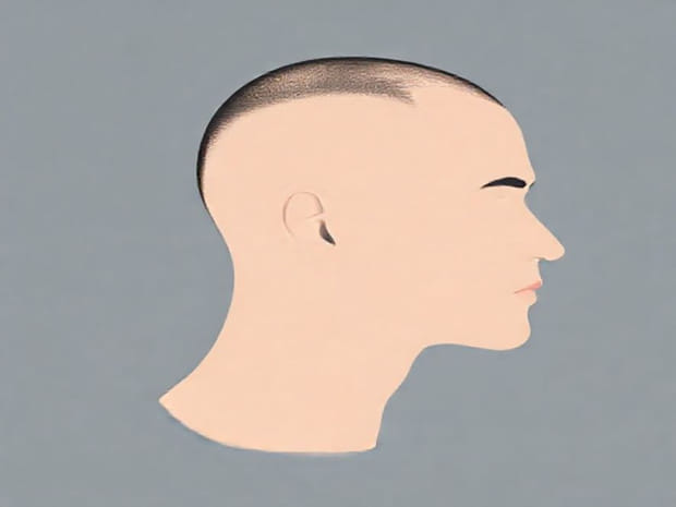 Is Androgenic Alopecia Permanent