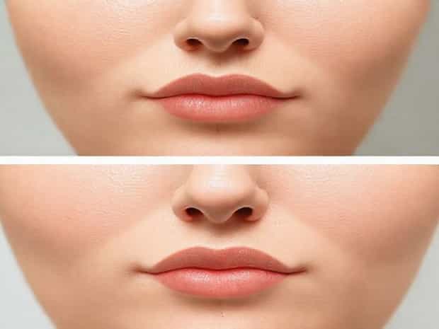 Jawline Dermal Fillers Before And After