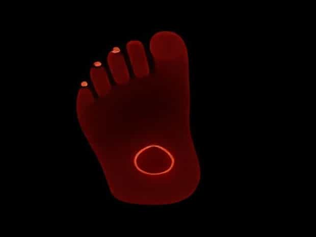 Keyhole Bunion Surgery Near Me