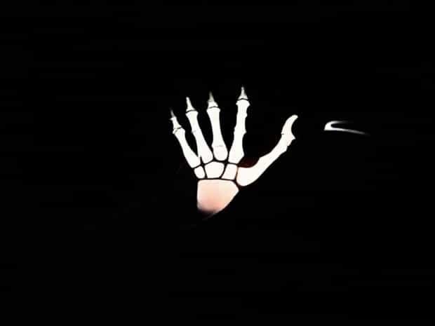 Is The Ulna In The Arm
